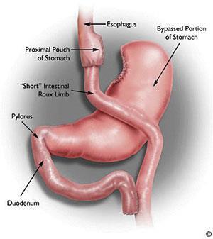 Gastroplasty (Stomach Stapling) complications Biliopancreatic diversion with Duodenal