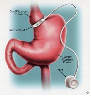 both through restriction of intake and absorption Roux-en-Y Gastric Bypass http://www.