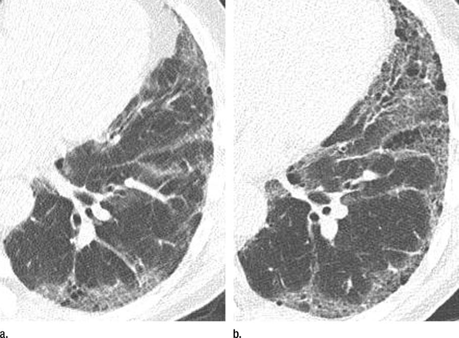 Figure 3 Figure 3: Low-dose chest CT images show usual interstitial pneumonia findings in 68-year-old male former smoker with 61.5 pack-years of cigarette consumption.
