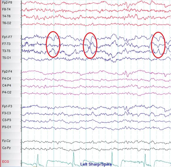2 Janice s electroencephalogram 3 Coronal magnetic resonance imaging scan of Janice s brain Abnormal sharp waves over the left temporal lobe are visible, with predominance in the anterior temporal