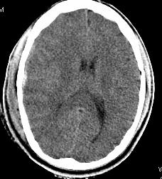fviia) Aggressive neuro tx (decomp crani, neuro crit care, hypertonic