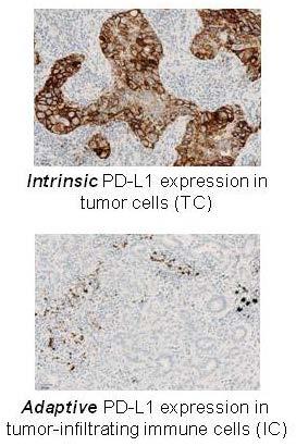 PD-L1 Expression on Tumor Cells (TC) and Immune Cells
