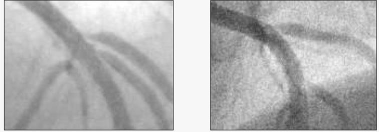 Side branch lesions Measurement of FFR in side branch lesions suggests that most of these lesions do NOT have functional significance, despite