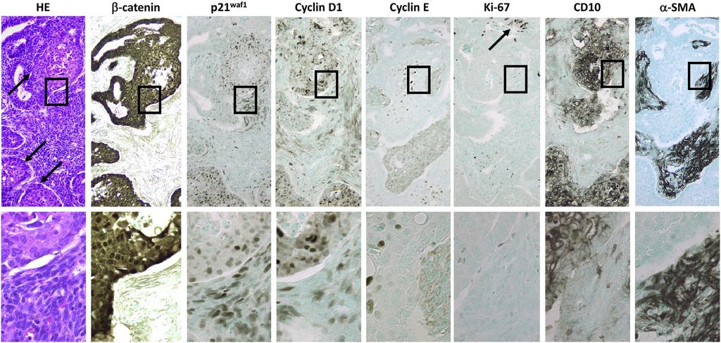 CTNNB1 mutations in APA 35 Fig. 1 Serial sections of APA. Hematoxylin and eosin (HE) staining and IHC for β-catenin, p21 waf1, cyclin D1, cyclin E, Ki-67, CD10, and α-sma.