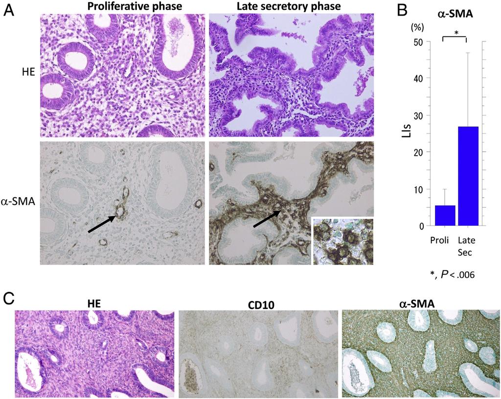 CTNNB1 mutations in APA 37 Fig. 3 Expression of α-sma and CD10 in stroma of normal endometrium and AM.