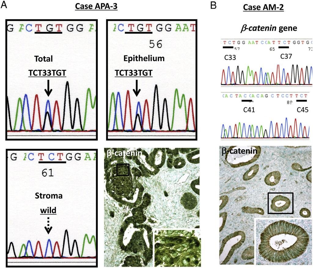 38 H. Takahashi et al. Fig. 4 Sequence analysis of exon 3 of CTNNB1 in APA and AM. A, Case APA-3.