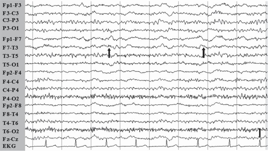 J.L. Fernández-Torre, et al. D Figure 2. D) EEG disclosing occasional slow waves localized on the left frontal and anterior temporal areas when patient s mental status was normalised. Low filter: 0.