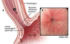 LOWER OESOPHAGEAL SPHINCTER The lower esophageal sphincter is a high-pressure zone