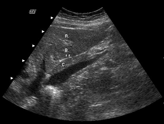 Abdominal Sonography Review 3 9. You are asked to perform a Doppler study on the hepatic veins in the liver. What differentiates the hepatic veins from the portal veins? A.