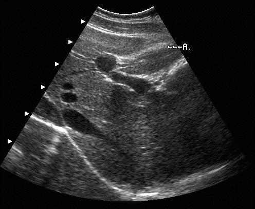 Abdominal Sonography Review 4 C. Posterior right lobe D. Anterior right lobe E. Quadrate lobe 14. What structure does the letter B represent? A. Ligamentum teres B. Falciform ligament C.