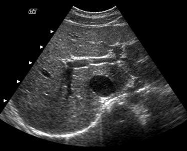 Abdominal Sonography Review 5 B C. A. D. Questions 17 20 refer to this image of the liver. 17. Identify the anatomy labeled A. A. Main portal vein B. Right posterior portal vein branch C.