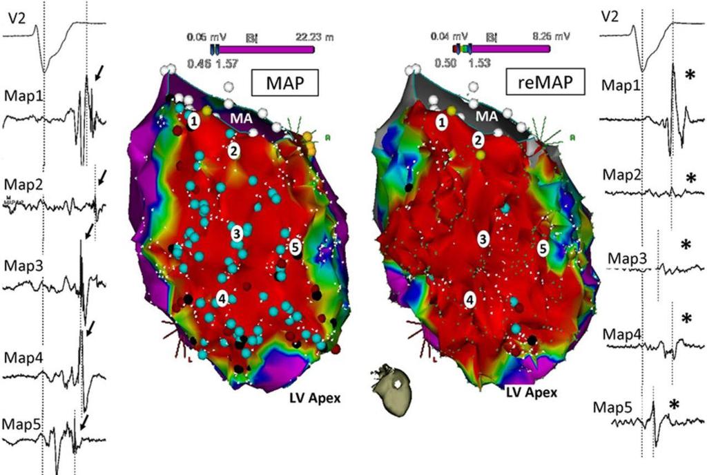 Inferior view of bipolar voltage electroanatomic substrate maps during sinus rhythm before (MAP) and after (remap) scar