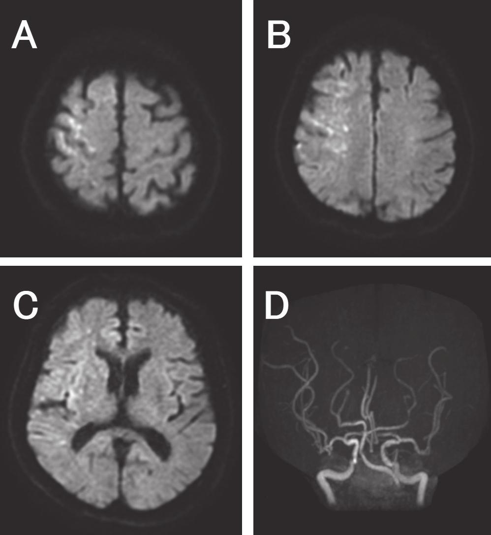 (A) and no major intracranial artery occlusion (B). Fig.