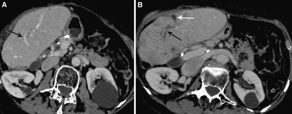780 J. C. Spina et al.: MDCT findings after hepatic chemoembolization Fig. 3. A 45-year-old male patient with melanoma liver metastases.