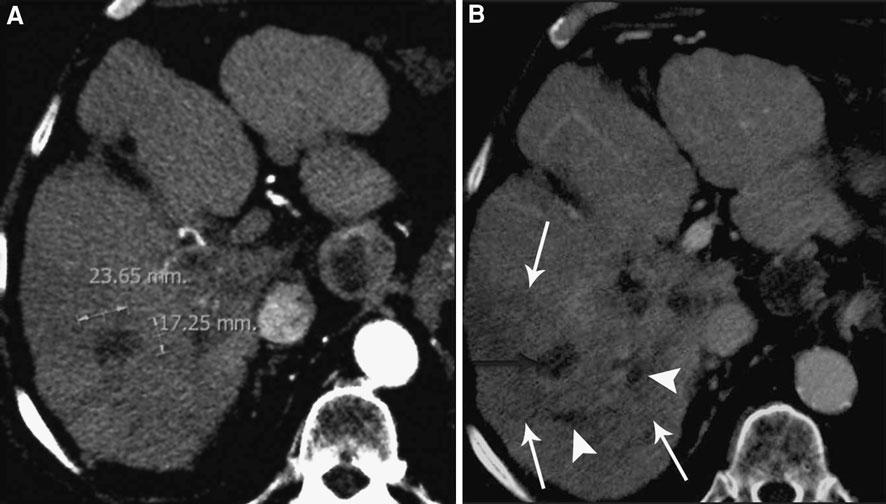 J. C. Spina et al.: MDCT findings after hepatic chemoembolization 781 Fig. 5. A 30-year-old male patient with carcinoid liver metastases (not shown).