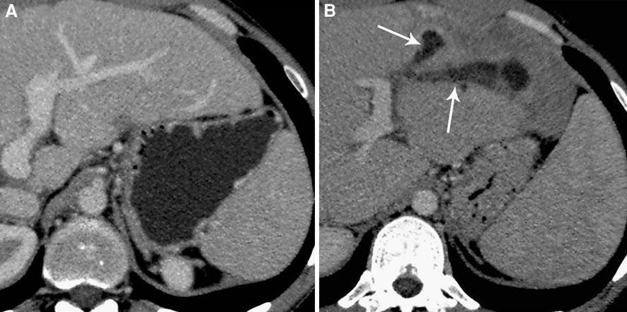 B 5 months follow-up portal venous phase CT after TACE-DC-beads through the lobar branch of the left hepatic artery shows periportal edema associated with bile duct dilatation and complete