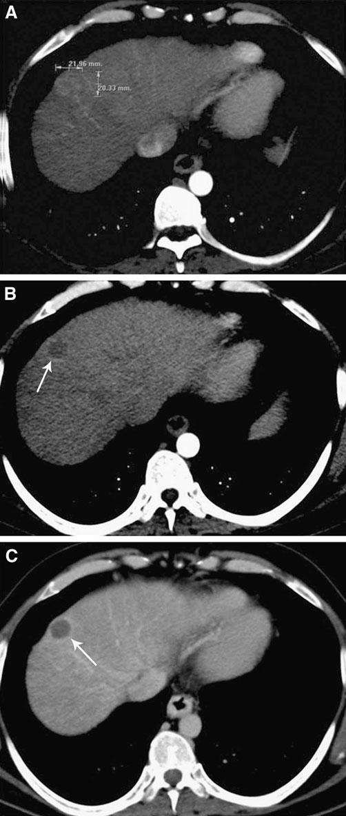 782 J. C. Spina et al.: MDCT findings after hepatic chemoembolization Fig. 7. A 69-year-old male patient with HCC (not shown).