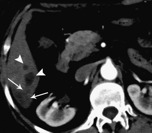 extravasation of bile along connective tissue sheaths of Glisson capsule, may obliterate the adjacent portal vein branch [16].
