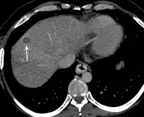 J. C. Spina et al.: MDCT findings after hepatic chemoembolization 783 Fig. 9. Same patient of Fig. 8.