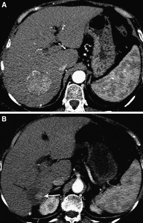 A 63-year-old female. A Cirrhosis and HCC in left lateral segment (arrow). B Two-month CT follow-up shows complete tumor necrosis of the treated lesion.