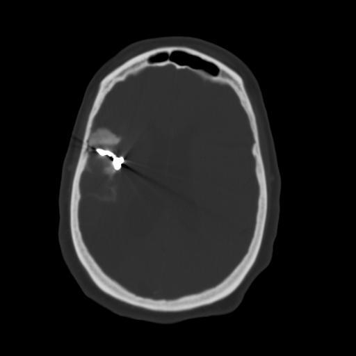 CT Head Showing