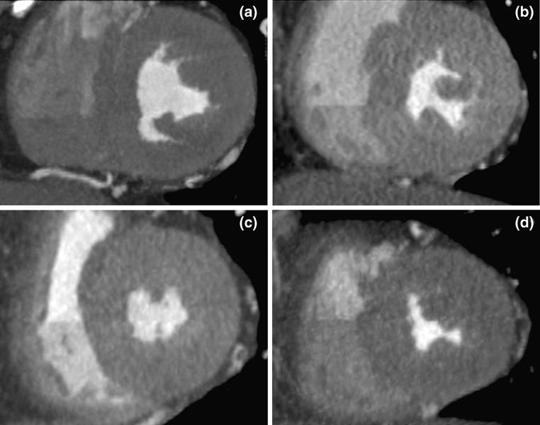 Q3.Additional applications of low dose techniques Calcium score CT High pitch DSCT with 120 kvp and 80 mas: 0.