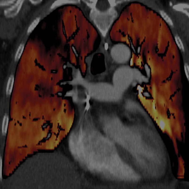 Dual Energy CT for Iodine distribution --41-yearold woman with pulmonary embolism Occlusive thrombus Thieme, S. F. et al.