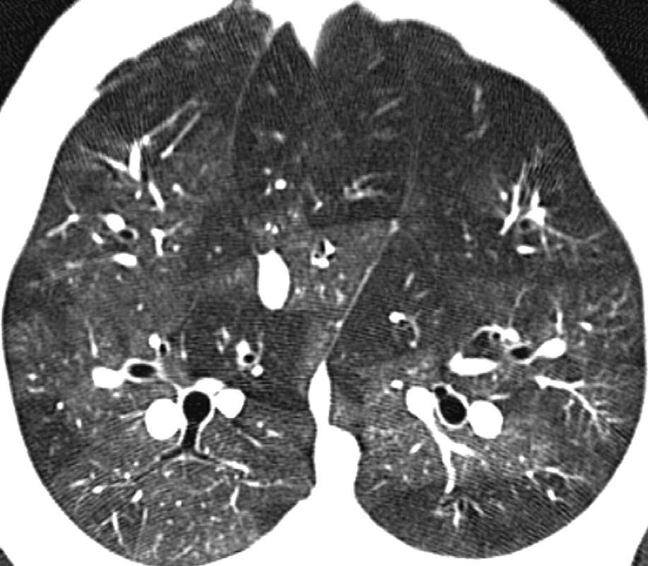 Acute PE: Ground Glass Opacities Acute PE induces GGO in unobstruct ed lung zones.