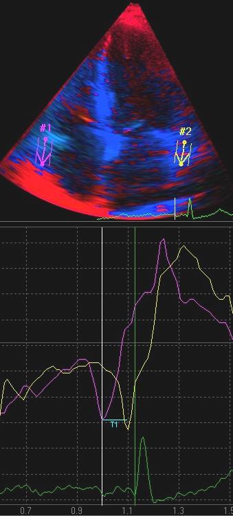 Methods Doppler echocardiography Mitral E, A, e velocities Mitral E/A, E/e ratios Mitral and