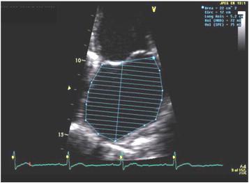 Methods Doppler echocardiography LA volumes (Simpson) Vmax VpreA Vmin LA function reservoir :LA expansion index (Vmax-Vmin/Vmin x