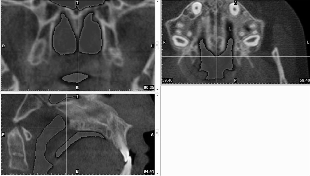 3D PHARYNGEAL AIRWAY AND MAXILLARY SINUS CHANGES 703 Figure 3. Identification of PNS point in axial, coronal, and sagittal views.