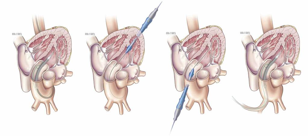 Approaches to TAVR Minimally invasive transcatheter aortic valve replacement (TAVR) may involve either a percutaneous (transfemoral or transaxillary/ subclavian) approach or an open (transapical or