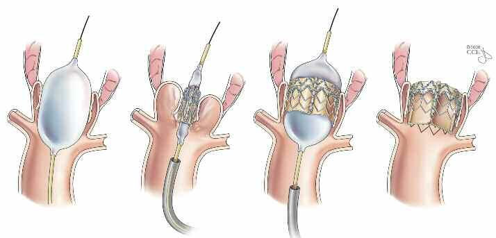 FDA-approved valves for TAVR The Food and Drug Administration (FDA) has approved two types of valves for transcatheter aortic valve replacement (TAVR).