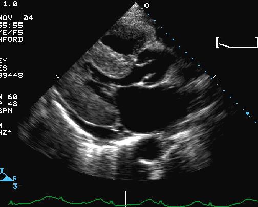 RV AORTA LV ATRIUM Effusion Figure 2. Echocardiographic Findings of Cardiac Amyloid (Courtesy of R. Falk, MD) a parasternal long-axis view in systole in a patient with severe cardiac amyloidosis.