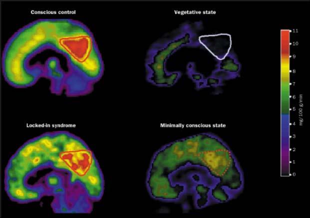 20 States of reduced consciousness following brain injury Resting brain metabolism in patients following brain injury and in healthy control