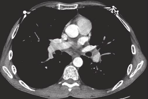 patient with a primary lung carcinoma in the right lung (not shown). The axial CT view shows no morphologically abnormal lymph nodes ().