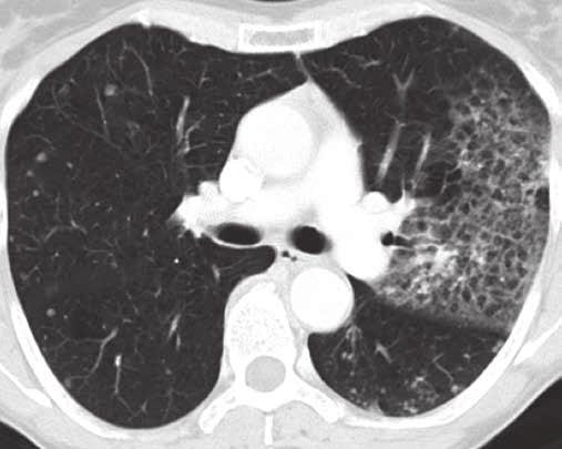 ased on this image, it is unclear which part of this mass represents tumoral tissue, and which mass component is solely retroobstructive atelectasis or other associated non-neoplastic changes.