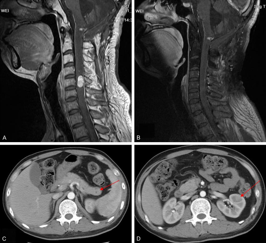 Figure 1. A. Preoperative sagittal T1-weighted contrast-enhanced MRI showing two enhancing nodule in the medulla oblongata and 5 th cervical cord. B.