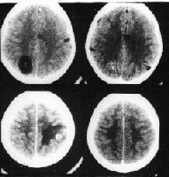 10.5 Diagnosis Cysts on neuroimaging o CT (better at diagnosing calcified lesions) o MRI (better at diagnosing cysts) Spinal disease per myelography Serology: o ELISA