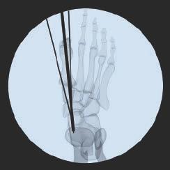 8 mm guide wire, under image intensifier control, through the upper center of the first metatarsal head close to the dorsal cortex and straight across