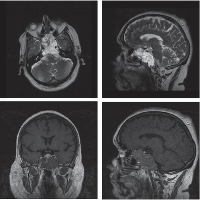 They may cause mass effect in the sellar, parasellar or suprasellar region resulting in visual disturbance or endocrine dysfunction and account for < 2% of all intracranial neoplasms.