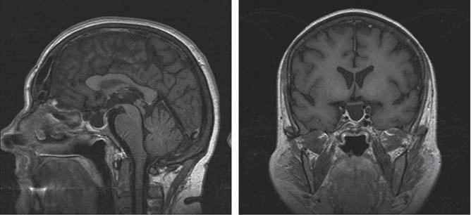 Ectopic Posterior Lobe An ectopic posterior lobe is usually not an incidental finding but is found in diagnostic imaging studies for GH deficiency [15 18].