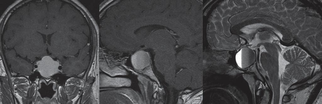 ment can either be surgically or with neuromodulatory drugs [29]. Patients with Cushing s disease, who cannot be controlled by pituitary surgery, may have to undergo bilateral adrenalectomy.