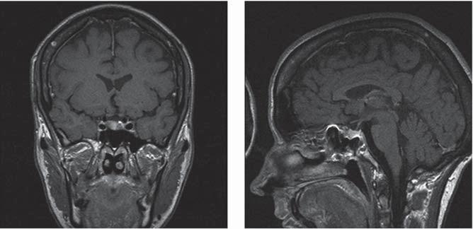 tion of a pituitary adenoma is referred to as pituitary apoplexy with an impressive clinical presentation, i.e., acute onset of headache, vomiting, ophthalmoplegia and visual loss [41, 42].