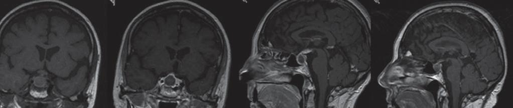 Patients usually present with headache, visual impairment, hydrocephalus, or hypopituitarism. Although suprasellar in origin, about 50% of craniopharyngiomas extend into the sella.