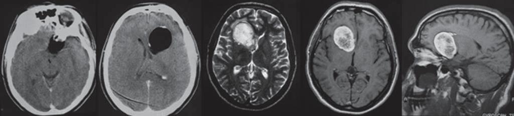 In CT and MRI, craniopharyngioma has a typical heterogeneous appearance with cystic and solid components and frequently (approximately 93%) abundant calcifications (Figure 10) [62, 65].