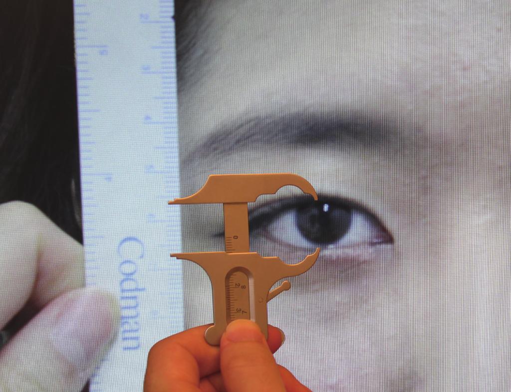 placed on top the monitor; (B) Caliper was then used to measure the amount pull on the eyebrow in relation to the actual increase in vertical fissure the