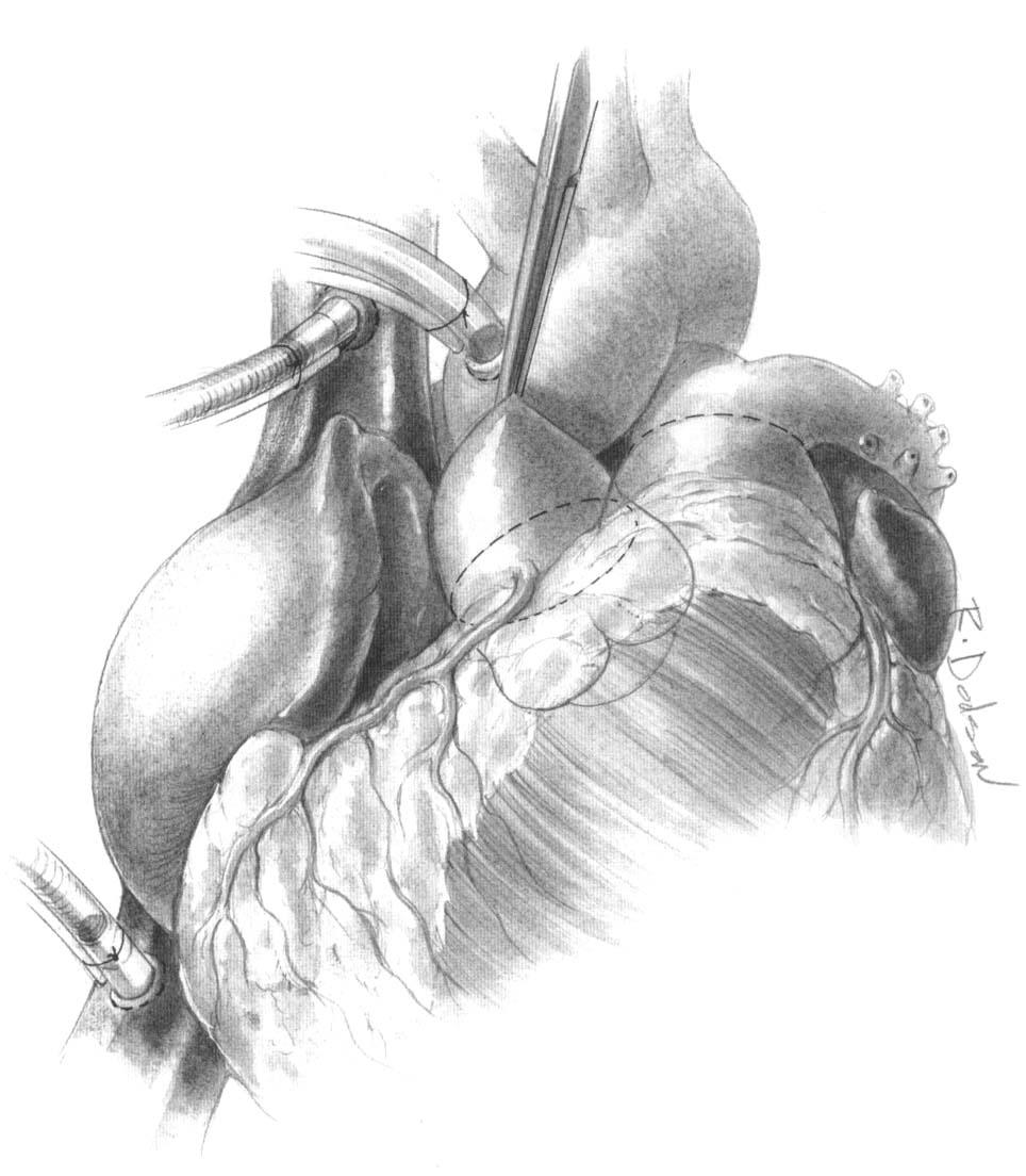 APPRUSAI, OF ROSS PROCEDURE 291 SURGICAL TECHNIQUE 1 The initial incision is placed transversely, approximately 2 cm above the commissures of the native aortic valve and divides the aorta completely.