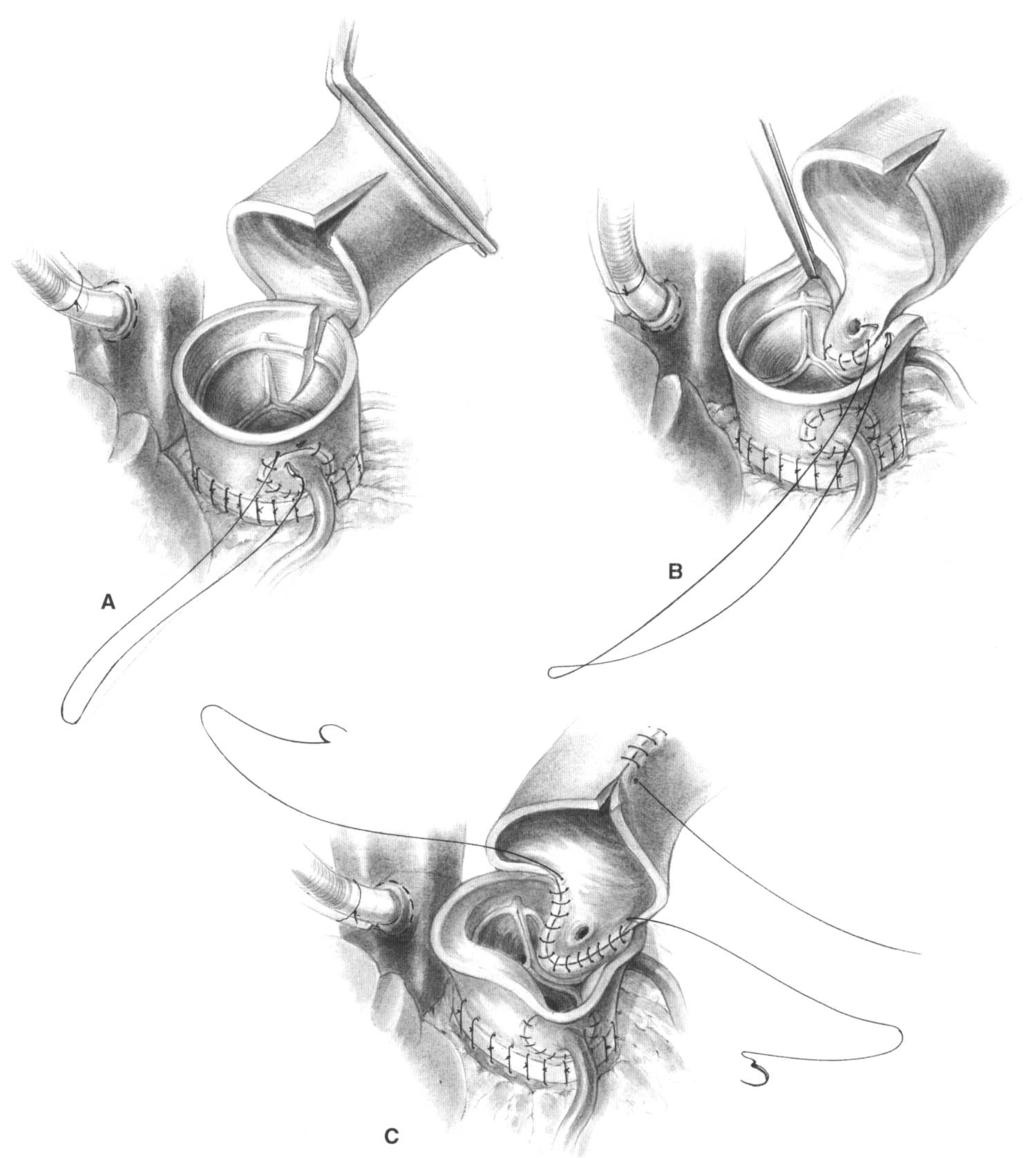 APPRAISAL. OF ROSS PROCEDURE 297 6 Two alternative methods for insertion of the pulmonary autograft. (A) The autograft is placed through a vertical incision into the left coronary sinus.