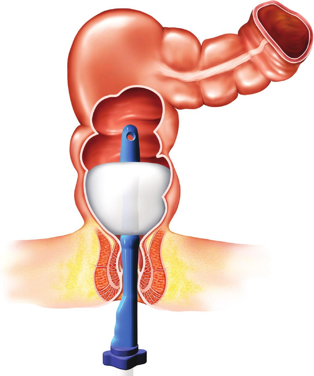 Diseases of the Colon & Rectum Volume 52: 2 (2009) 287 Transanal irrigation was carried out using either a rectal balloon catheter (Fig.